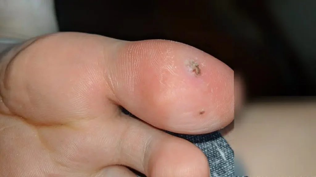 木酢液クリアをイボに塗り始めて27日