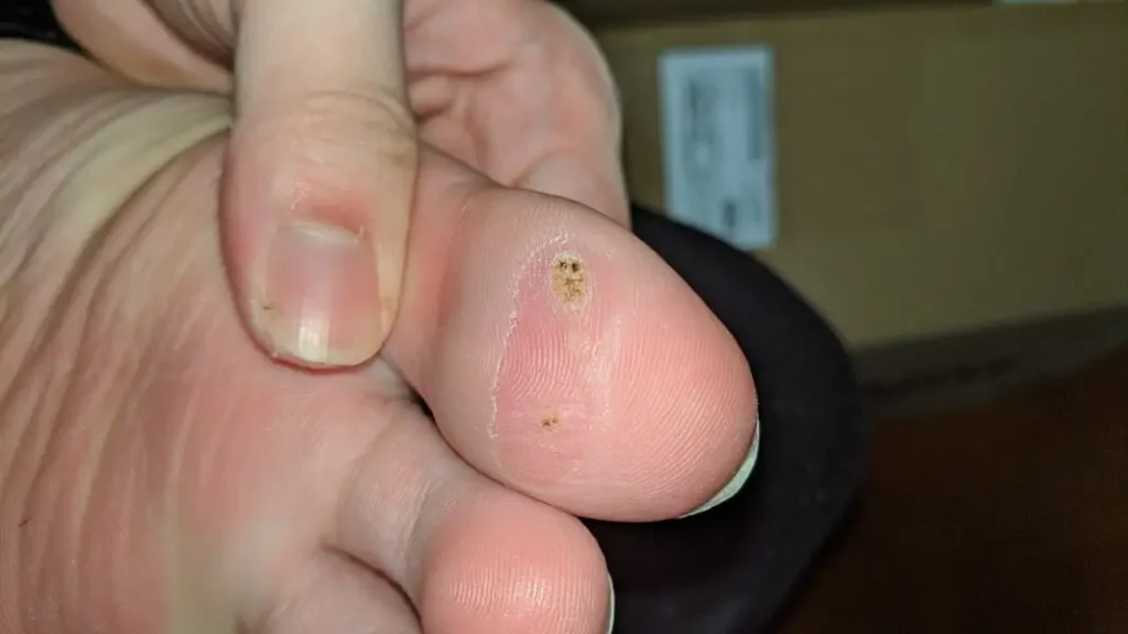 木酢液クリアをイボに塗り始めて37日