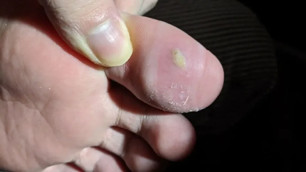 木酢液クリアをイボに塗り始めて46日