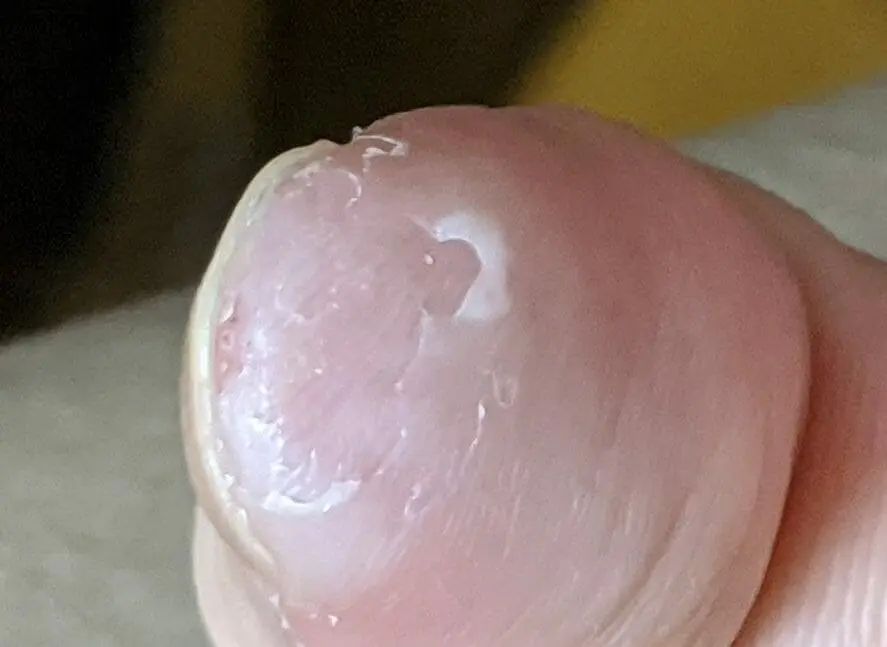 木酢液クリアで皮膚がボロボロの状態